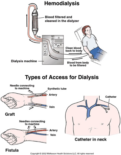 Dialysis Catheter Types